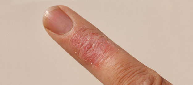 száraz dermatitis pikkelysömör kezelése